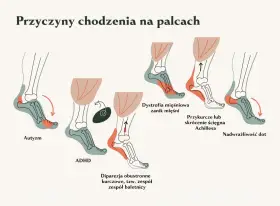 Ilustracja pokazuje przyczyny chodzenia na palcach, w tym autyzm, ADHD, dystrofię mięśniową, przykurcze ścięgna Achillesa i nadwrażliwość dotykową.