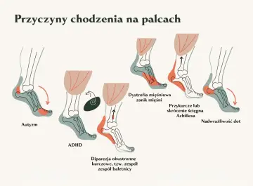 Ilustracja pokazuje przyczyny chodzenia na palcach, w tym autyzm, ADHD, dystrofię mięśniową, przykurcze ścięgna Achillesa i nadwrażliwość dotykową.